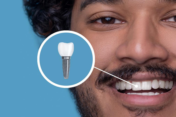 Dental Implants