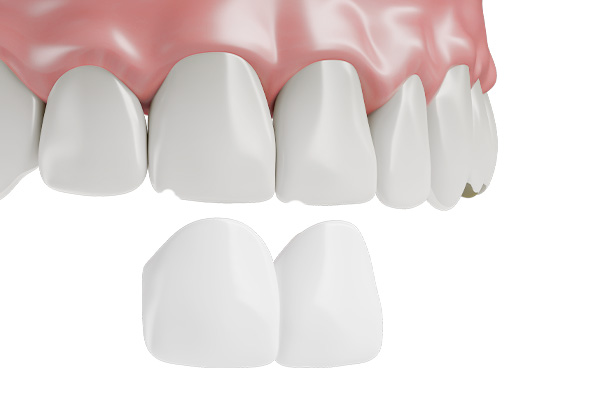 Dental Veneers Back