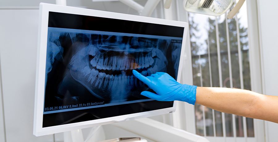 Digital Dental X-Rays