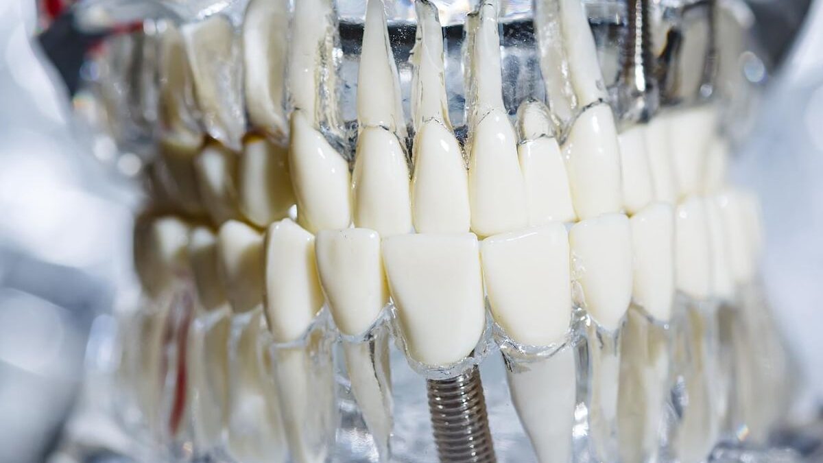 Do Dental Implants Change Your Smile?