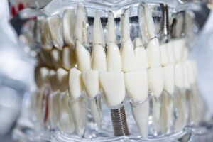 Do Dental Implants Change Your Smile?