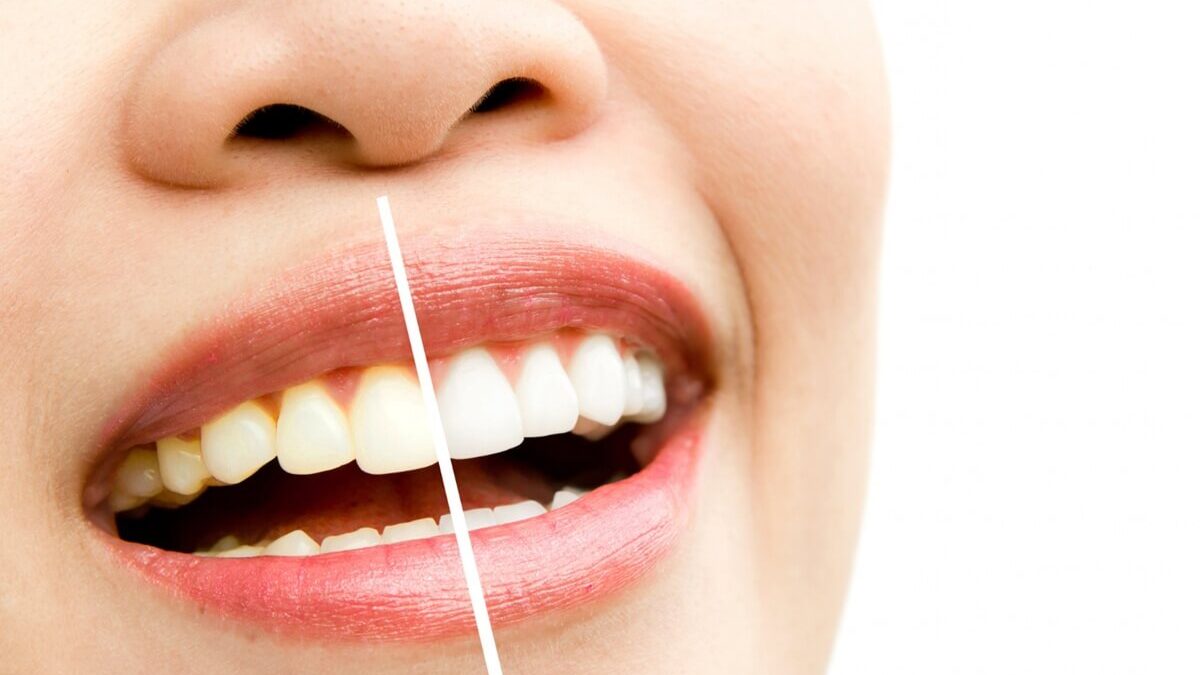 Do Dental Veneers Stain?