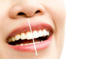 Do Dental Veneers Stain?