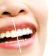 Do Dental Veneers Stain?
