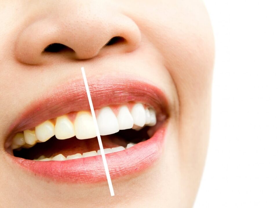 Do Dental Veneers Stain?