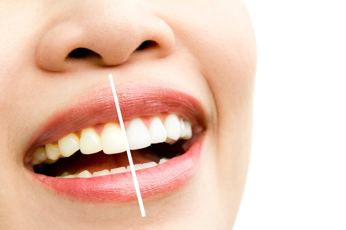 Do Dental Veneers Stain?