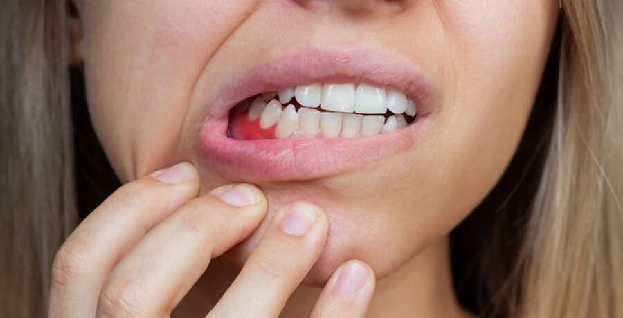 Emergency Tooth Extraction