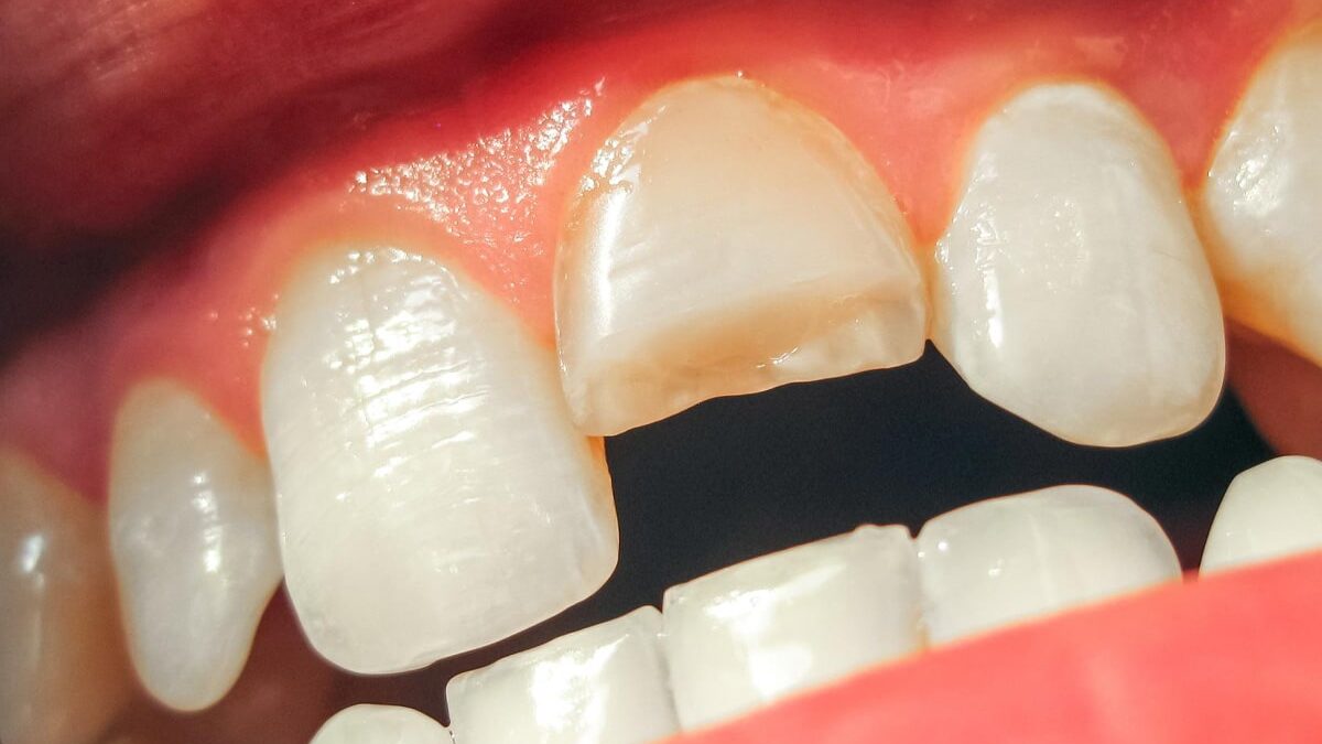 Fractured Tooth Symptoms: What You Need to Know
