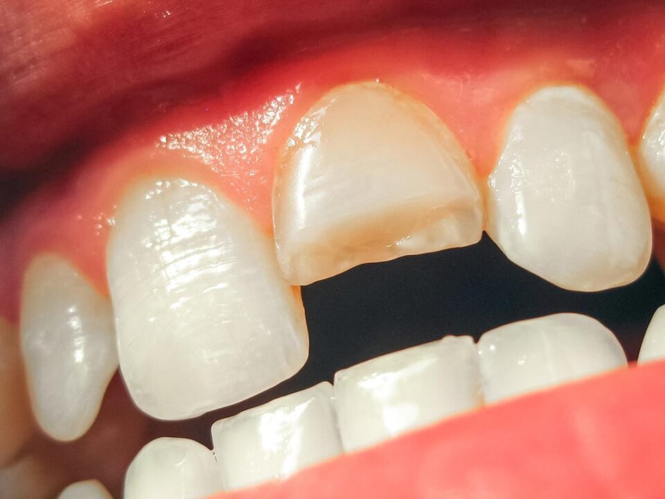 Fractured Tooth Symptoms: What You Need to Know