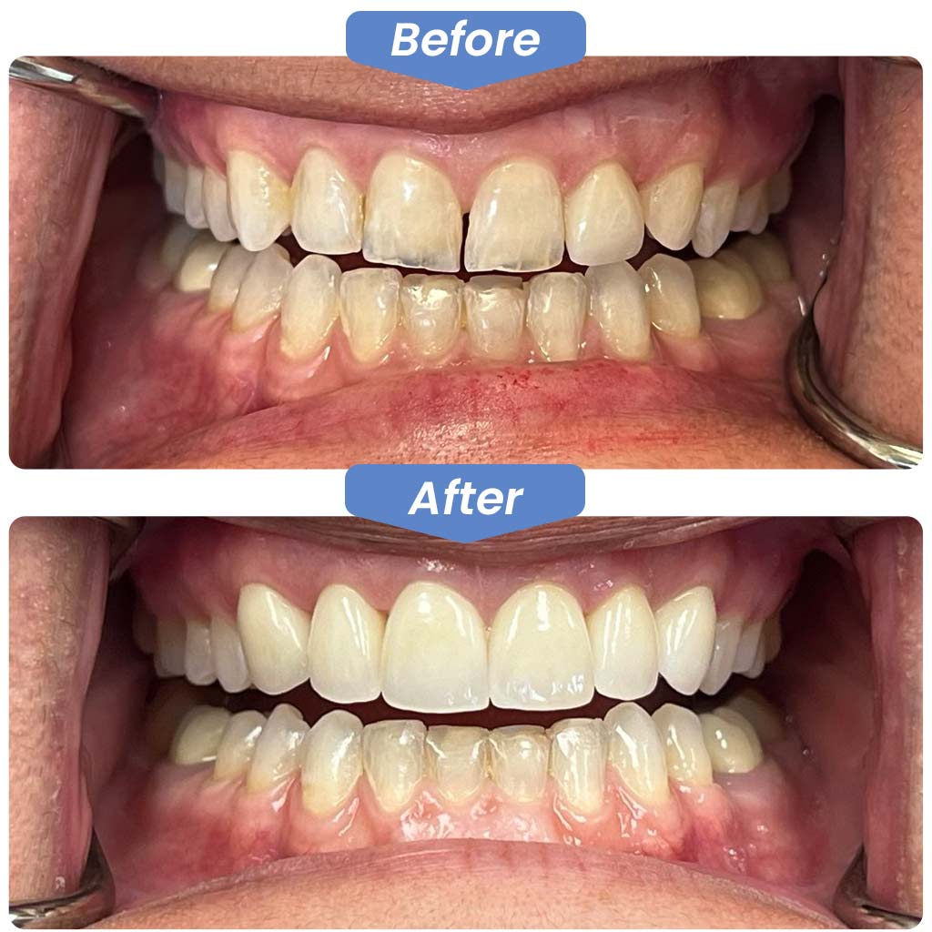 Front Teeth Crown Before After