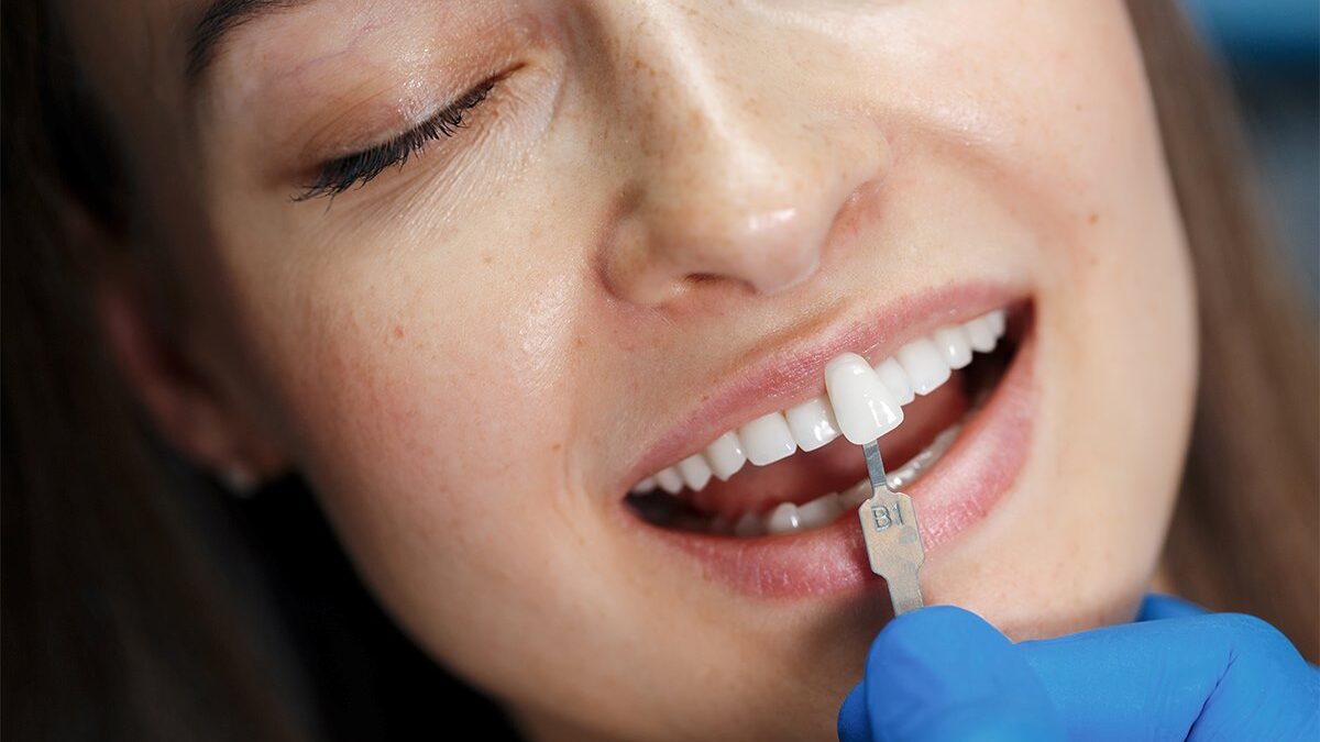 Front Tooth Repair with Composite Fillings