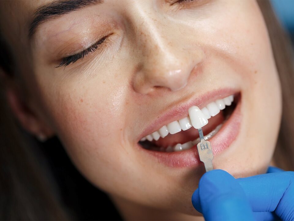 Front Tooth Repair with Composite Fillings