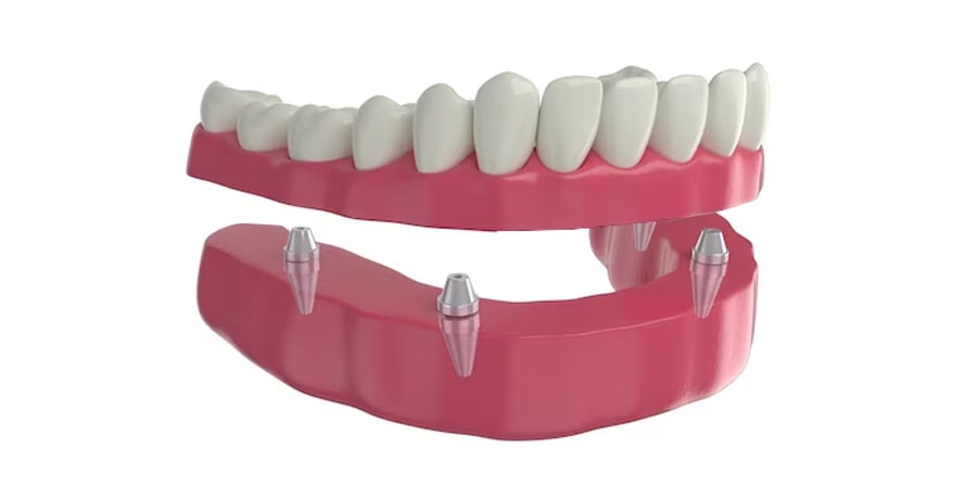 Full-Arch Restoration with Implants