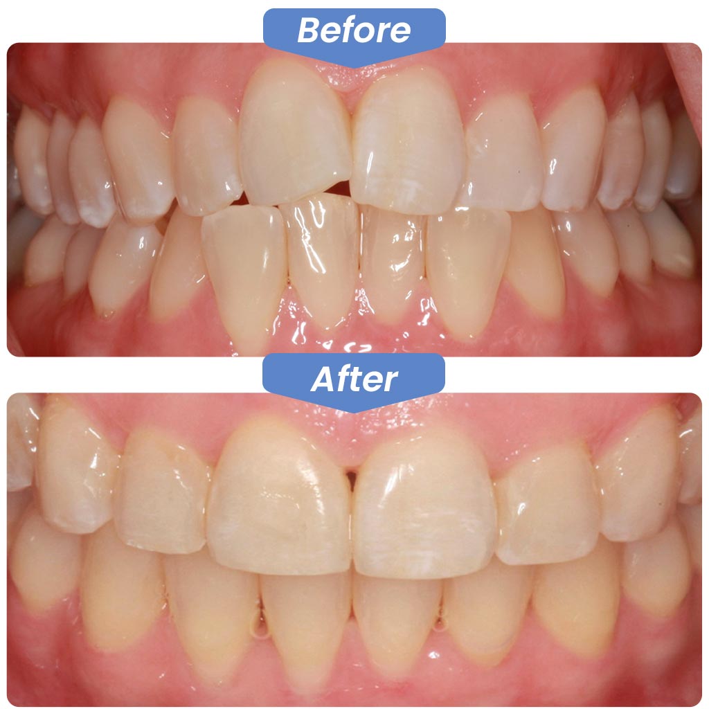 Gallery Before After, Kirkland Dental