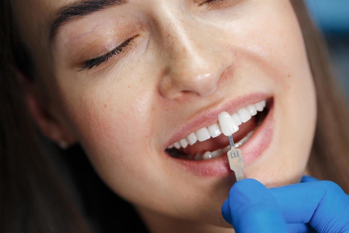 How Long Do Dental Veneers Typically Last?