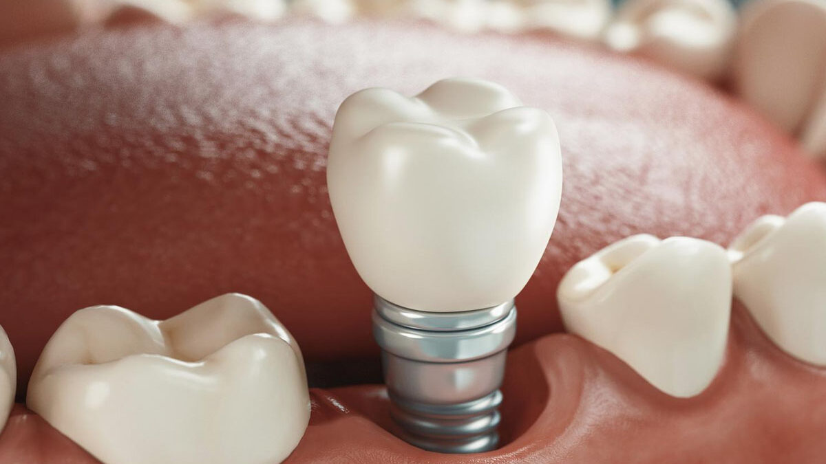 How Much Are Dental Implants?