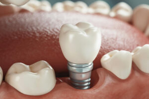 How Much Are Dental Implants?