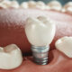 How Much Are Dental Implants?