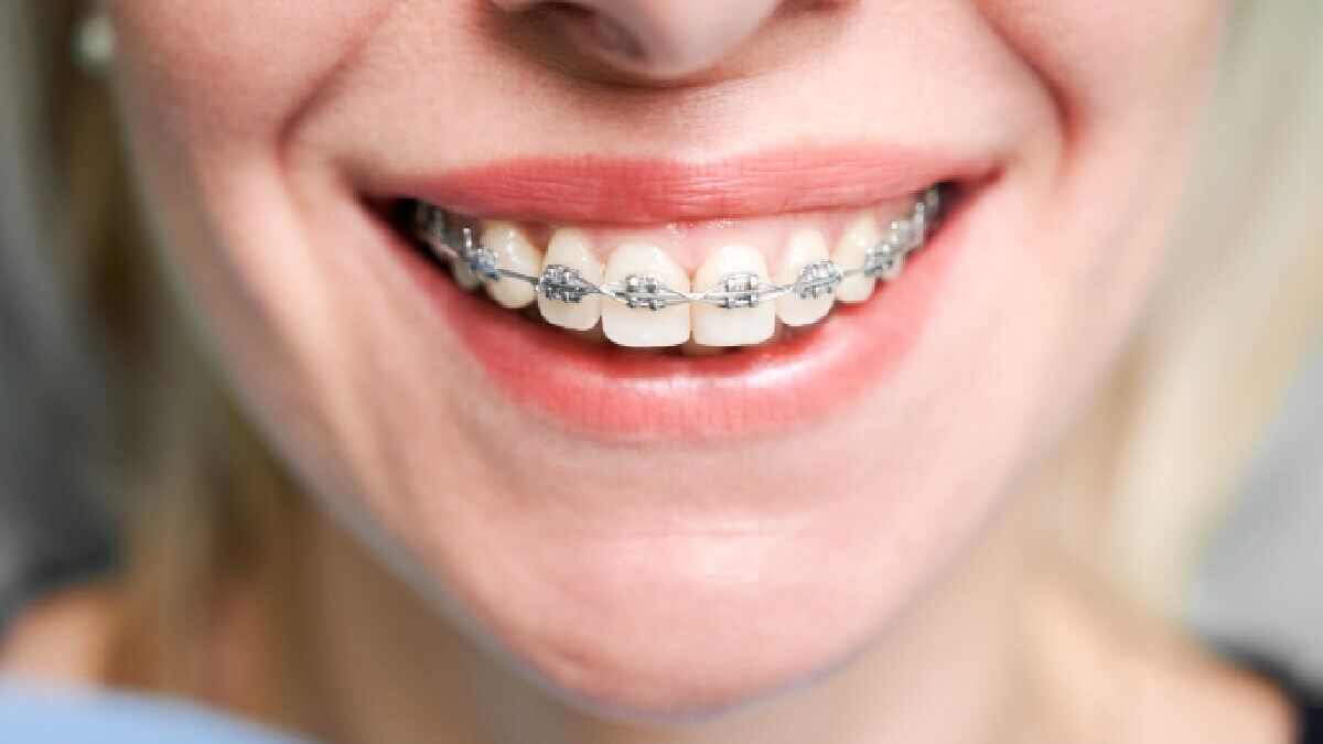 How Much is the Cost of Orthodontic Braces in Washington