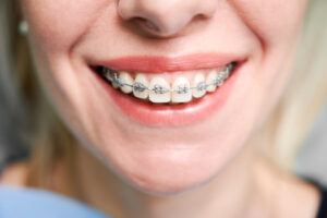 How Much is the Cost of Orthodontic Braces in Washington