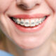 How Much is the Cost of Orthodontic Braces in Washington
