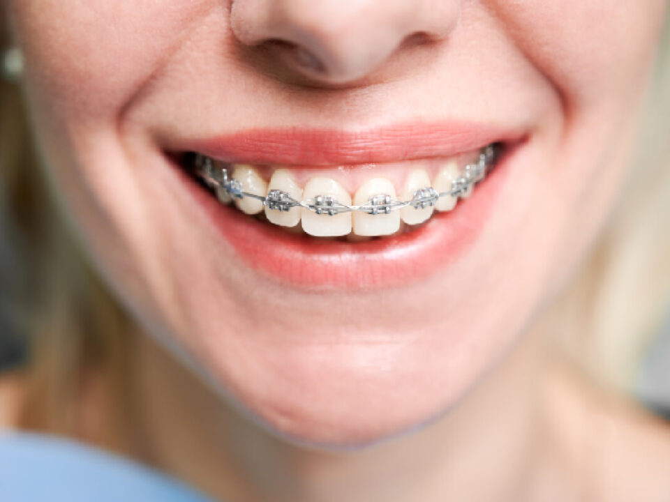 How Much is the Cost of Orthodontic Braces in Washington