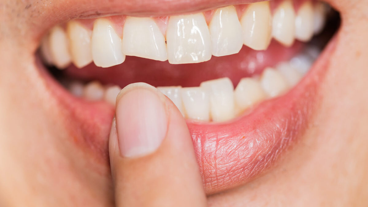 How To Fix A Chipped Tooth?