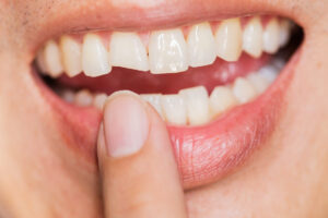 How To Fix A Chipped Tooth?