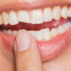 How To Fix A Chipped Tooth?