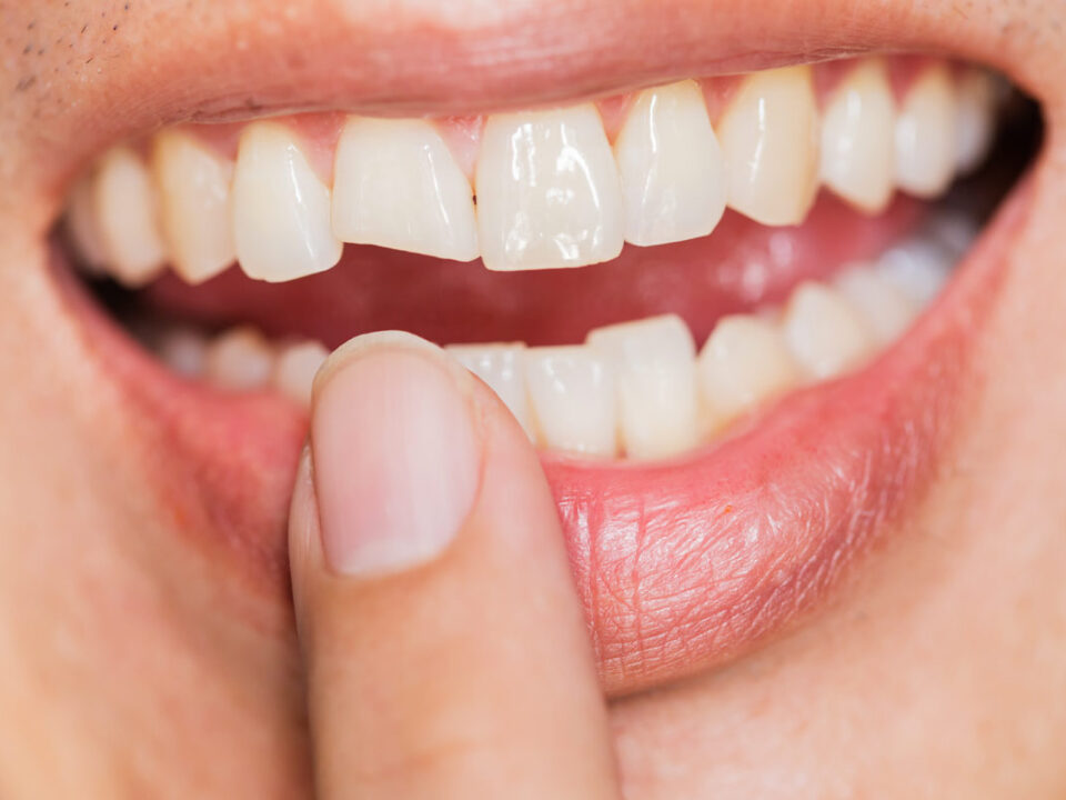 How To Fix A Chipped Tooth?