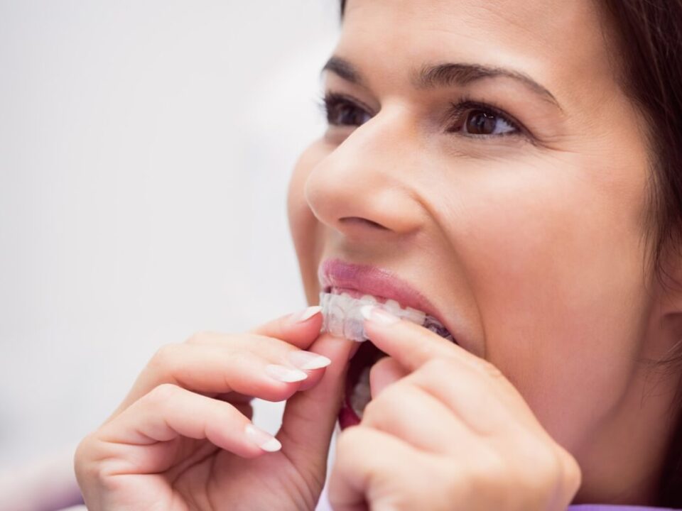 How to Take Care of Invisalign?