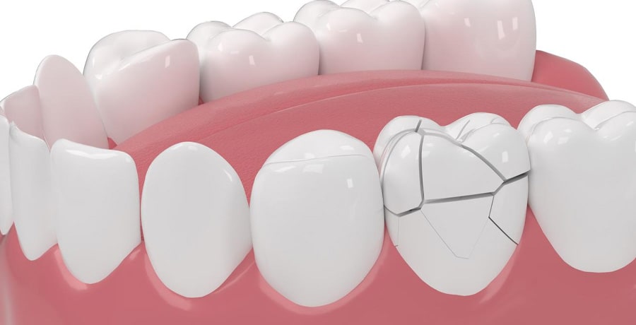 Implants for Broken or Damaged Teeth