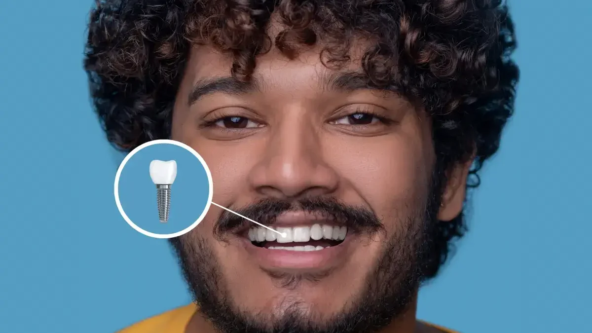 Insurance Coverage for Dental Implants in Washington