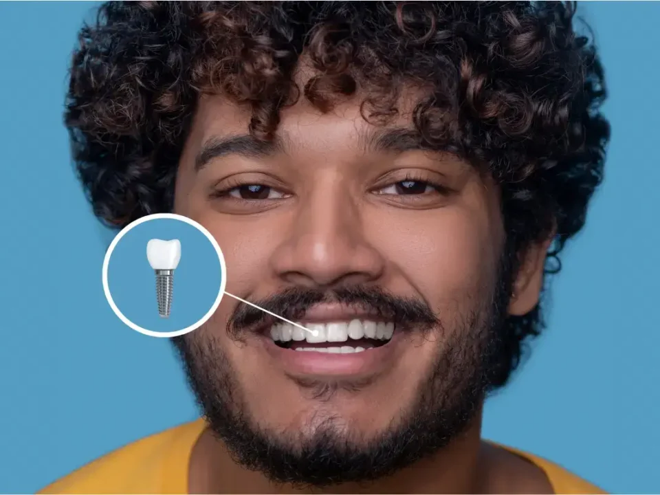 Insurance Coverage for Dental Implants in Washington