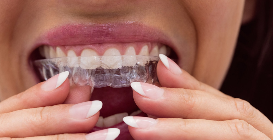 Invisalign Clear Aligners