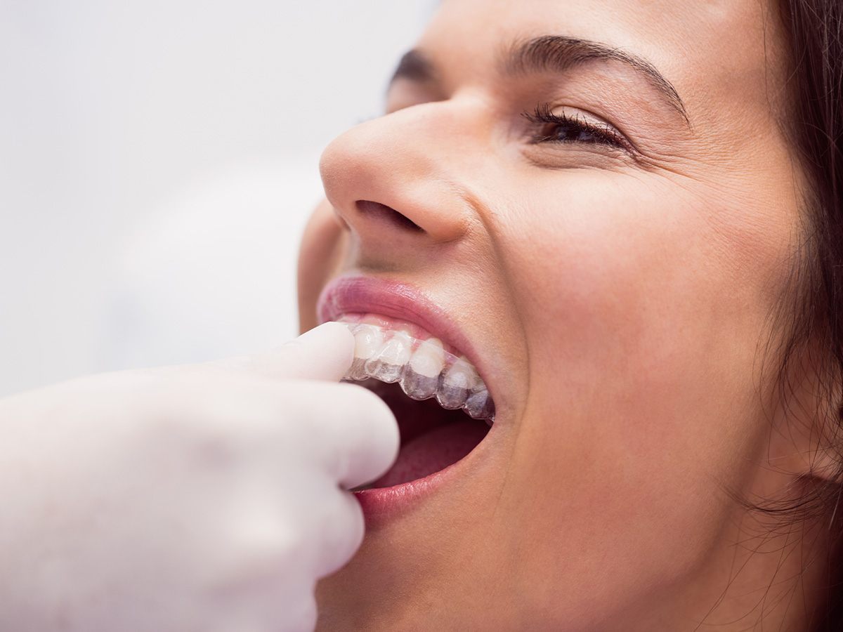 Is 20 Hours Enough for Invisalign 1