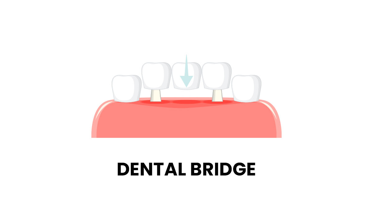 Is There a Dental Bridge for One Tooth?