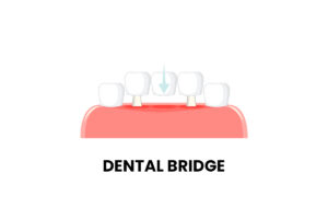 Is There a Dental Bridge for One Tooth?