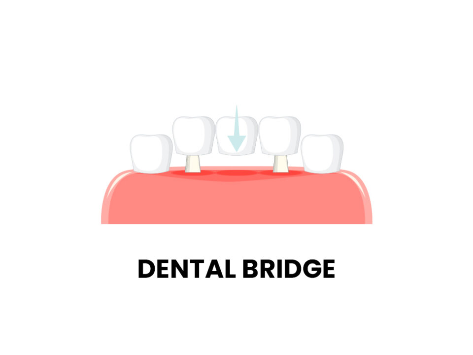 Is There a Dental Bridge for One Tooth?