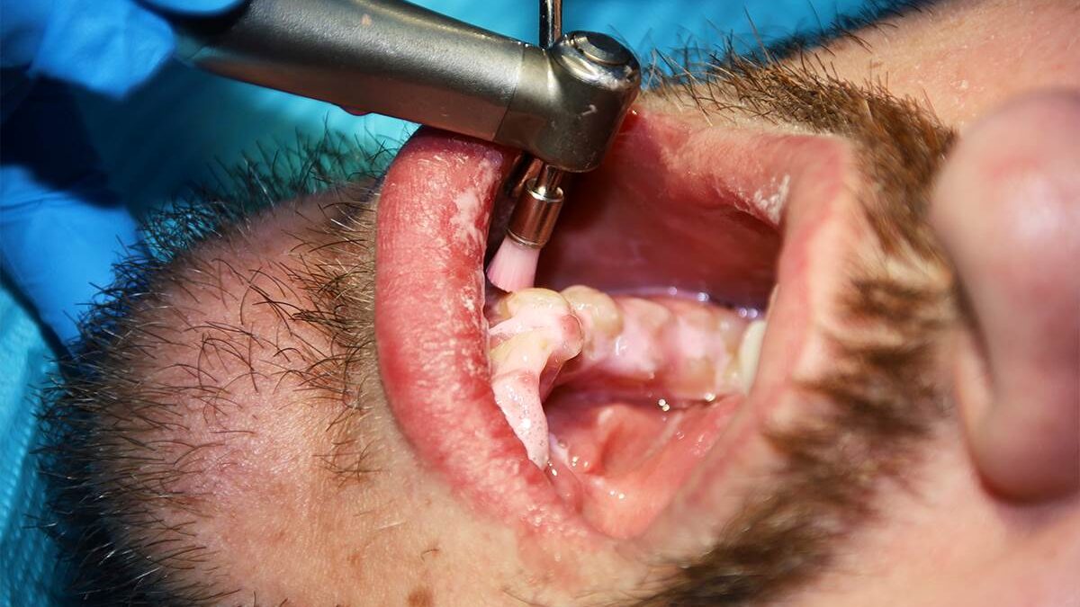 Is Tooth Scaling Painful?
