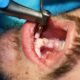Is Tooth Scaling Painful?
