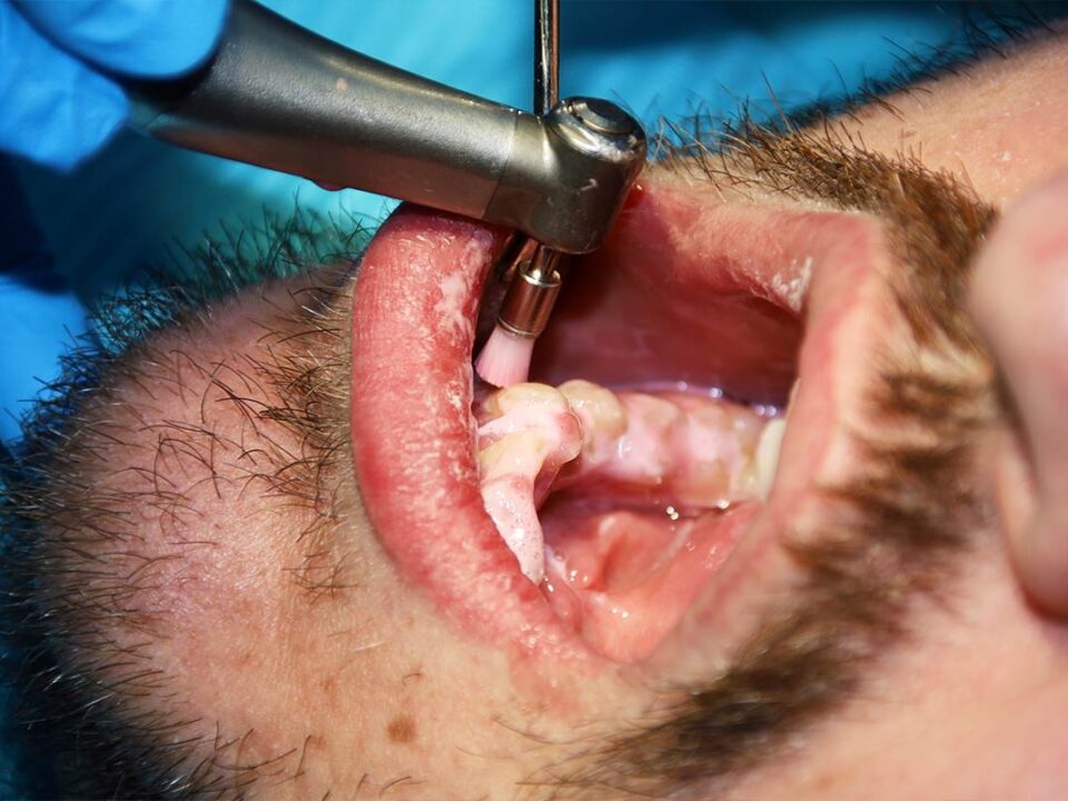 Is Tooth Scaling Painful?