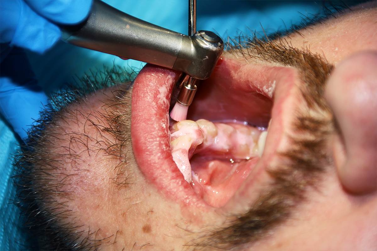 Is Tooth Scaling Painful?