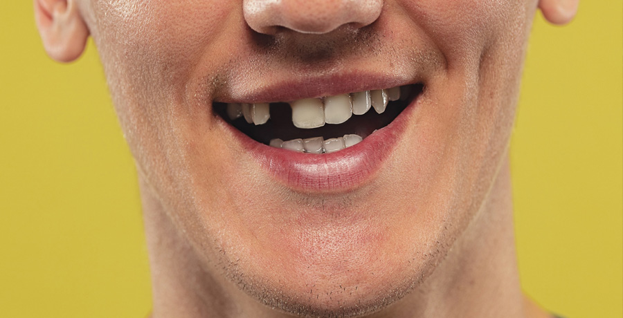 Knocked-Out Tooth