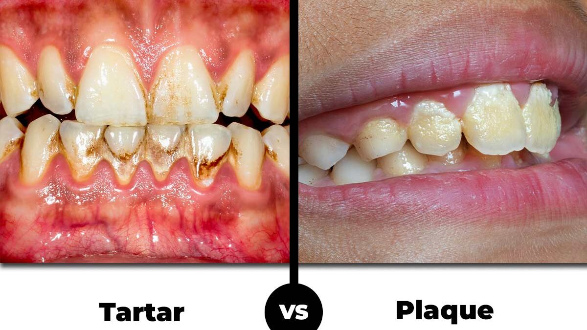 Plaque and Tartar: Key Differences You Should Understand