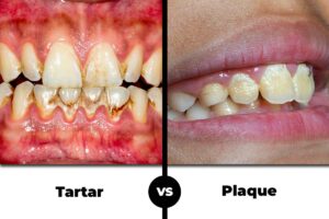 Plaque and Tartar: Key Differences You Should Understand