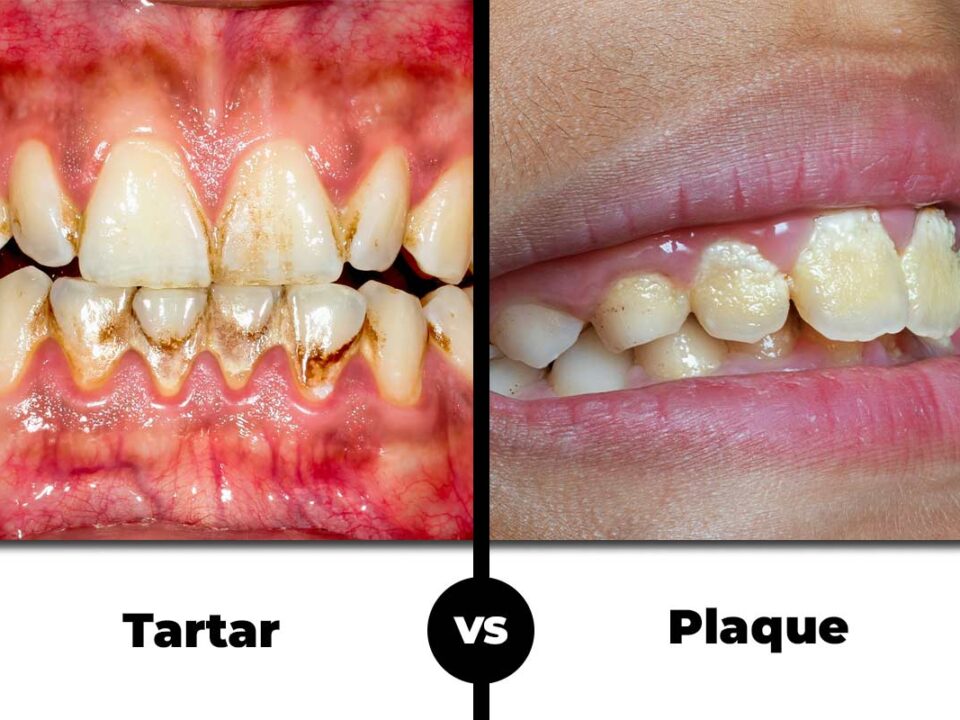 Plaque and Tartar: Key Differences You Should Understand
