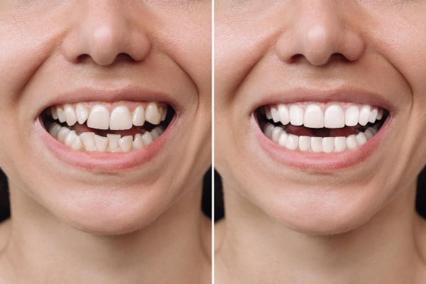 Composite Veneers Before After