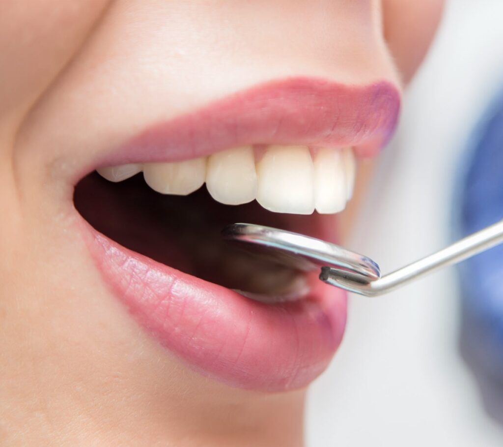 Porcelain Veneers Kirkland