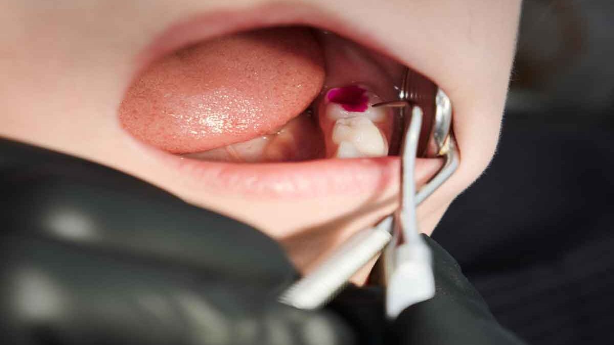 Signs Your Wisdom Teeth Need to Come Out